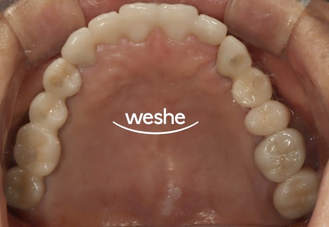 마곡역 치과 기공실과 기공소의 차이와 그에 따른 임플란트 진료 과정 관련 이미지 12