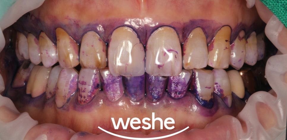 에어플로우와 초음파 스케일링 차이점과 단계별 치료 과정 강서구 치과 관련 이미지 4