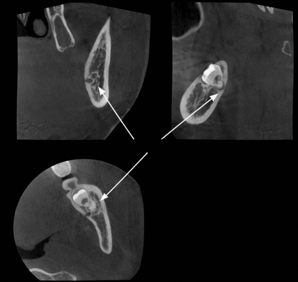 마곡동 치과 누운 매복 사랑니 발치, 신경과 가까울수록 구강악안면외과 전문의가 필요한 이유 관련 이미지 3
