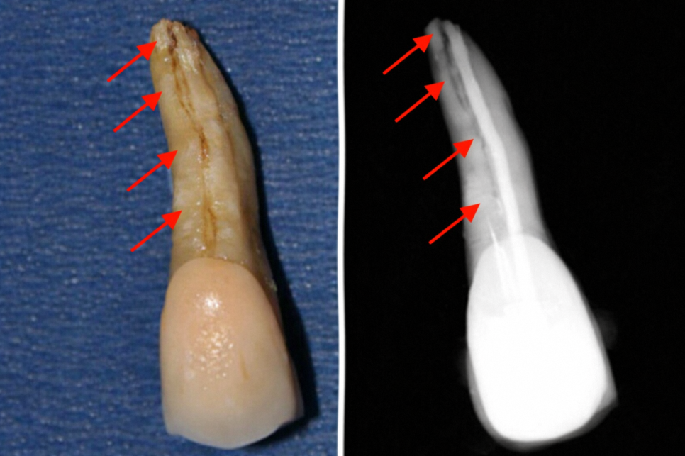 마곡역 치과 신경치료 후 크라운까지 마무리하는 진짜 이유와 지르코니아의 장점 관련 이미지 2