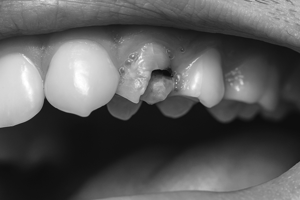 마곡 치과 이가 부러져서 뿌리만 남았어요 파절과 치아정출술 관련 이미지 2