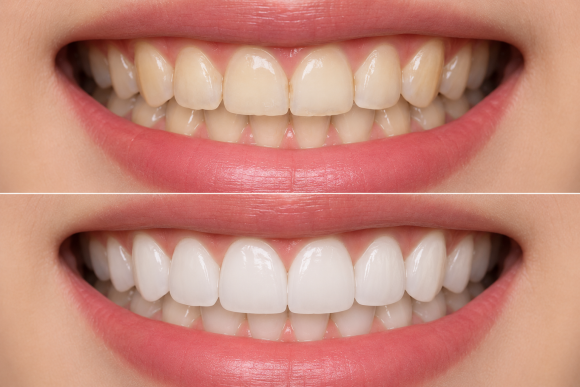 If Your Veneer Falls Off: When It Can Be Reattached and What to Do | Magongnaru Station Dental Clinic image 2