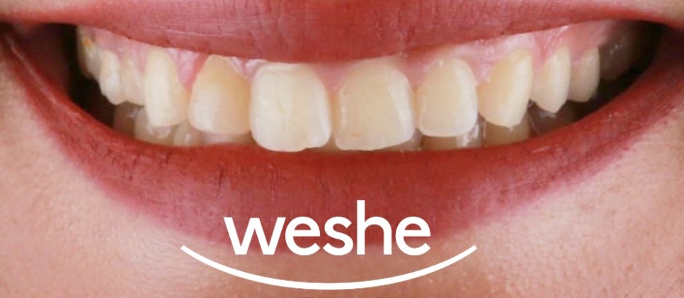 마곡역 치과 삐뚤빼뚤하고 치아 끝 살짝 깨진 앞니, 교정 대신 라미네이트 수복으로 치료 과정 관련 이미지 1