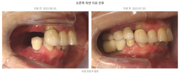 위 어금니 잇몸뼈가 부족하다면? 상악동 거상술이 필요한 이유 관련 이미지 5