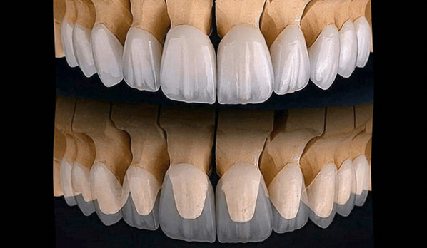 강서구 마곡동 치과 잇몸 경계의 검은 선, 지르코니아 크라운 으로 지울 수 있을까? 관련 이미지 3