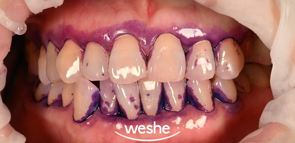 마곡동 치과 EMS 스케일링 관련 이미지 2