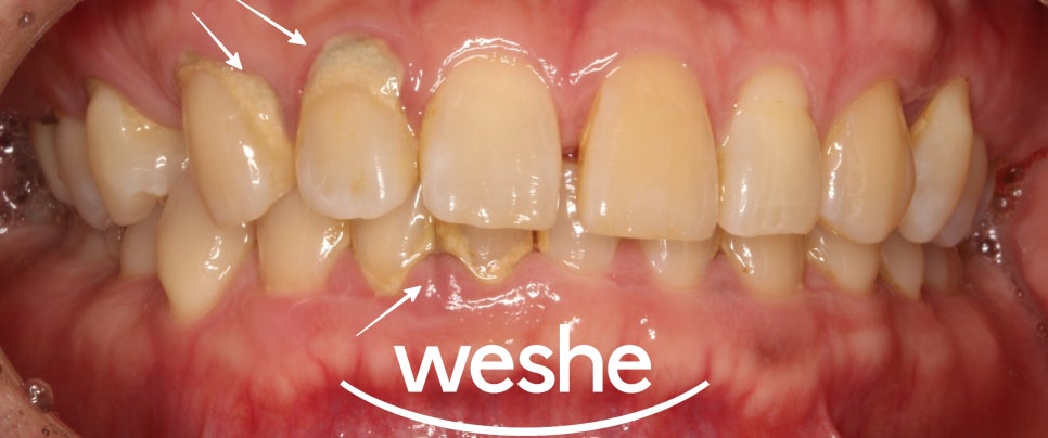 헛구역질(gagging reflex) 때문에 포기했던 구강진료, 해결할 수 있는 방법은? 마곡 수면치과 사랑니발치, 원데이 인레이, 치주치료 관련 이미지 2