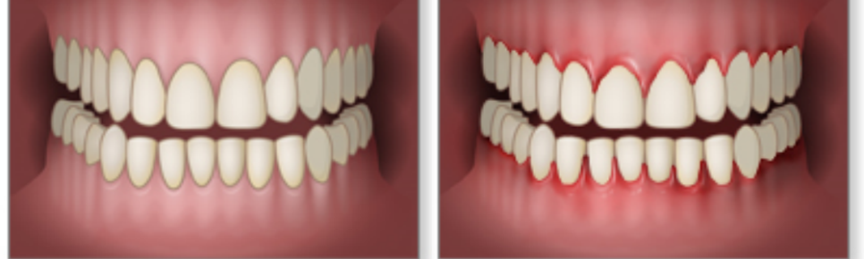강서구 치과 앞니 라미네이트 제작을 위한 단계 진단 및 분석 절차 과정은? 관련 이미지 3