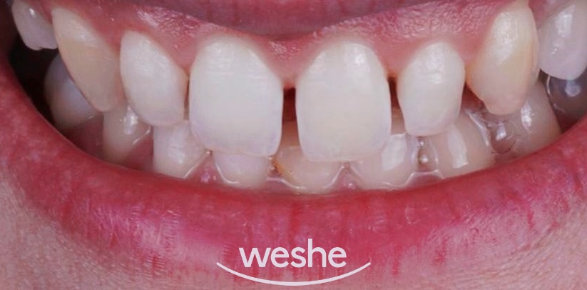 😁 웃을 때 치아 사이 가 벌어져 보인다면? 마곡동 치과 라미네이트 로 해결! 관련 이미지 2