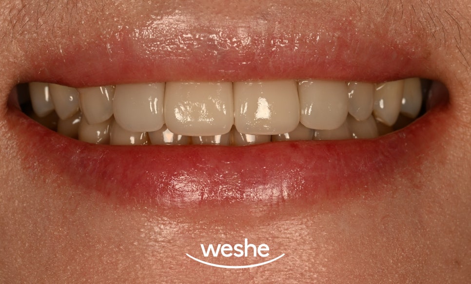 앞니 레진 변색, 티 안 나는 라미네이트 교체와 비율 개선할 수 있을까? 마곡역 치과 관련 이미지 6