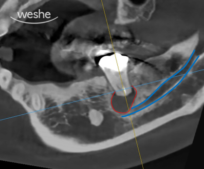 마곡역치과 치아, 진짜 뽑아야 되는 걸까요? 치아재식술이란? 관련 이미지 5