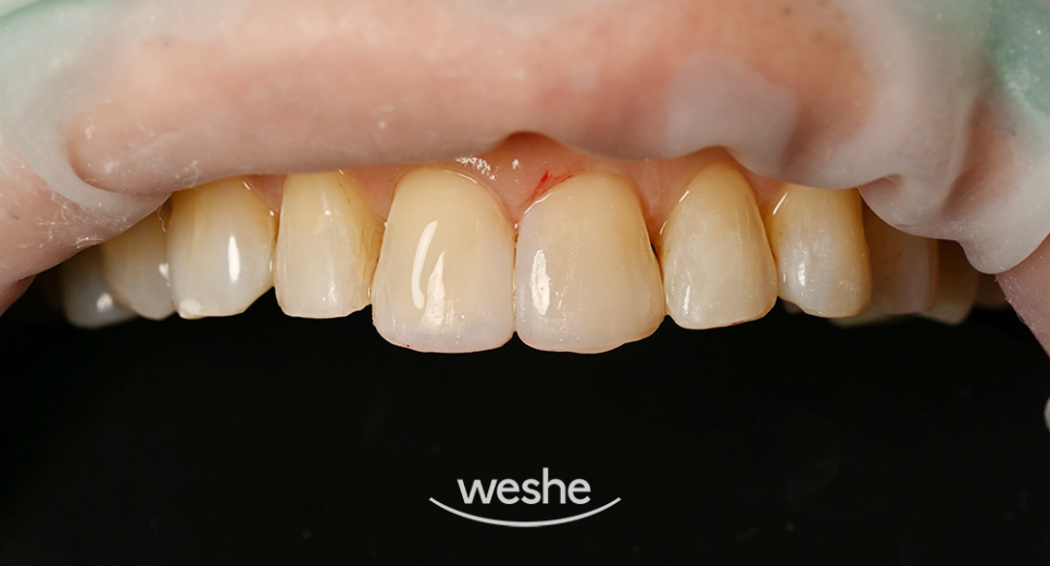 마곡역 치과 마모&middot;변색된 앞니, 레진 수복으로 자연스럽게 회복한 사례 관련 이미지 2