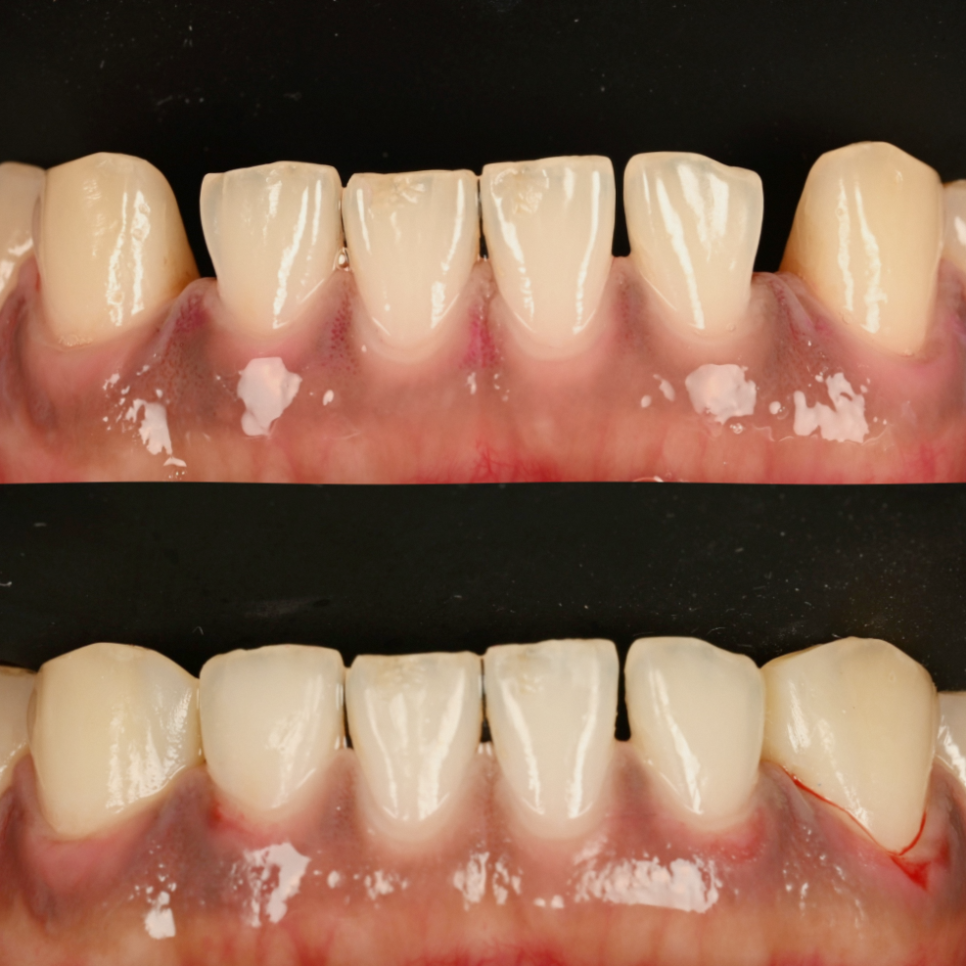 강서구 마곡 치과 벚꽃 시즌 전에 챙기는 심미치료 세 가지 관련 이미지 4