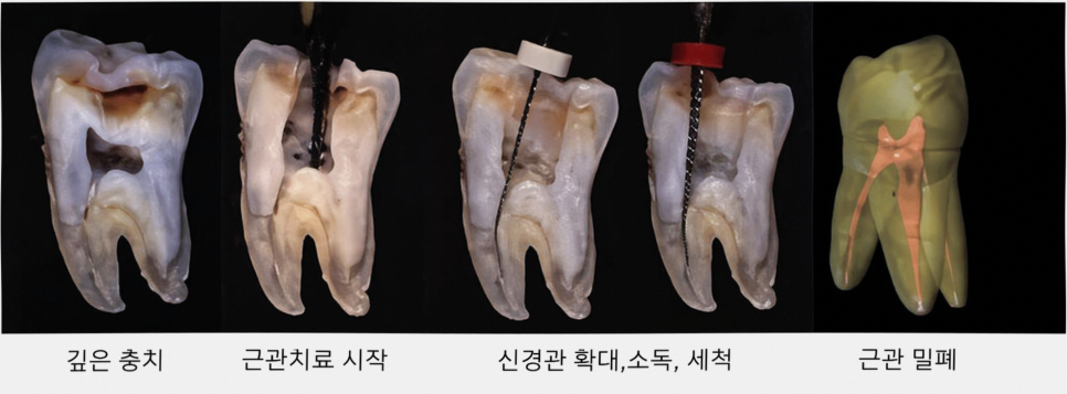 마곡역 치과 신경치료, 내원 횟수가 많다고 잘못된 것 아닙니다. 관련 이미지 1