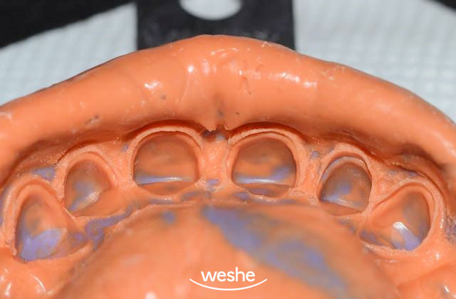 [강서구 치과] 치간이개, 앞니가 벌어졌다?! 치아 벌어짐, 초기 충치/ 라미네이트 치료 과정 관련 이미지 2