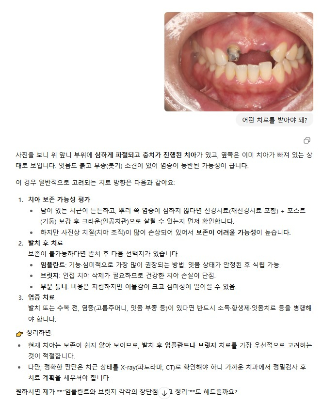 마곡역 치과 잇몸 아래 부러진 치아, 발치 없이 살릴 수 있는 방법은? 교정적 정출술을 동반한 신경치료 관련 이미지 1