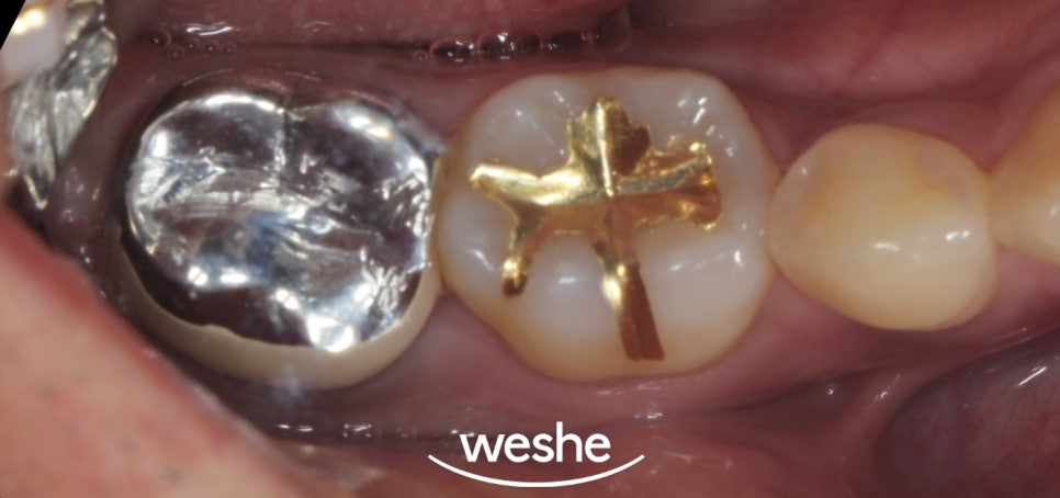 마곡 치과 어금니 통증 발치를 해야 될까? 그 전에 알아야 될 치아 재식술 관련 이미지 1