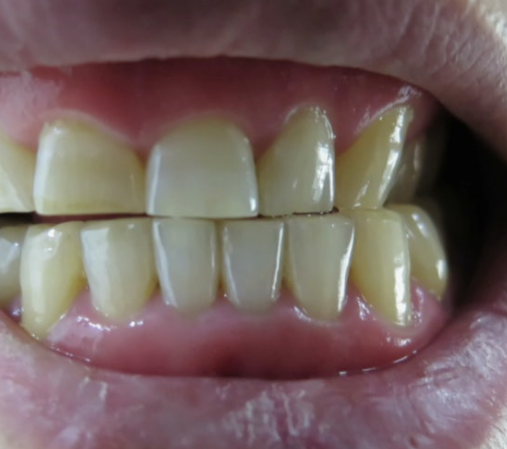 Can Teeth Break Because of Teeth Grinding? Magongnaru Station Dental Clinic image 2