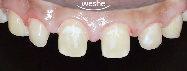 [강서구 치과] 치간이개, 앞니가 벌어졌다?! 치아 벌어짐, 초기 충치/ 라미네이트 치료 과정 관련 이미지 4