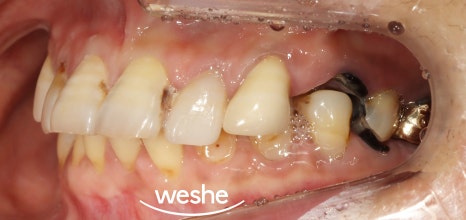 마곡역 치과 기공실과 기공소의 차이와 그에 따른 임플란트 진료 과정 관련 이미지 6