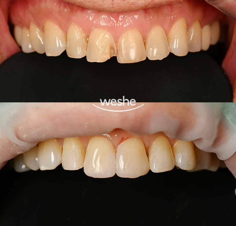 마곡역 치과 마모&middot;변색된 앞니, 레진 수복으로 자연스럽게 회복한 사례 관련 이미지 3