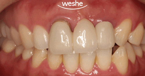 마곡역 치과 잇몸 아래 부러진 치아, 발치 없이 살릴 수 있는 방법은? 교정적 정출술을 동반한 신경치료 관련 이미지 2