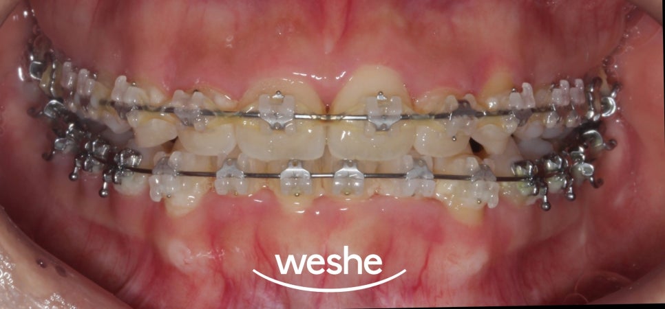 발산 치과 교정 중 칫솔질 어려우신가요? 브라켓 탈락 걱정 없이 깨끗하게, 에어플로우 세정 관련 이미지 2