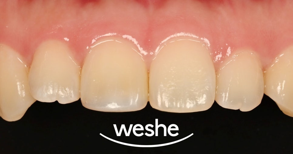 마곡 치과  앞니 깨짐, 크라운 없이 레진으로 치료가 가능할까? 진료 방법을 선택하는 기준과 과정 관련 이미지 5