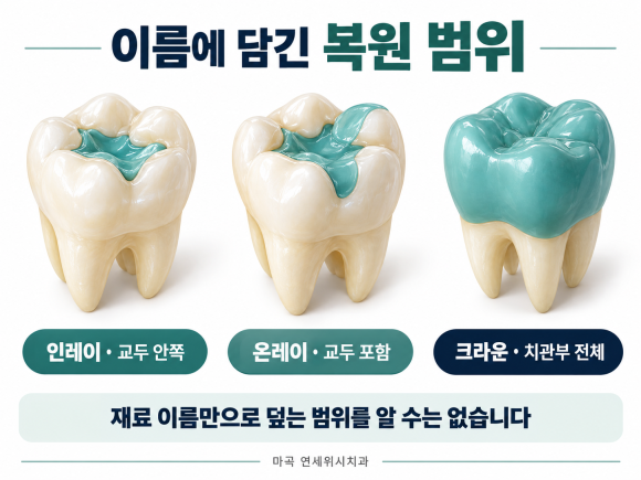 마곡 치아색 충치치료, 레진과 인레이가 다르게 들리는 이유 관련 이미지 3