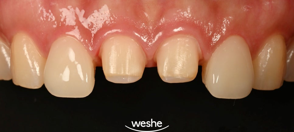 앞니 치아 파절, 마곡 치과 치료 기준과 지르코니아 크라운의 심미적 비율 관련 이미지 3