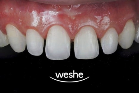 😁 웃을 때 치아 사이 가 벌어져 보인다면? 마곡동 치과 라미네이트 로 해결! 관련 이미지 8