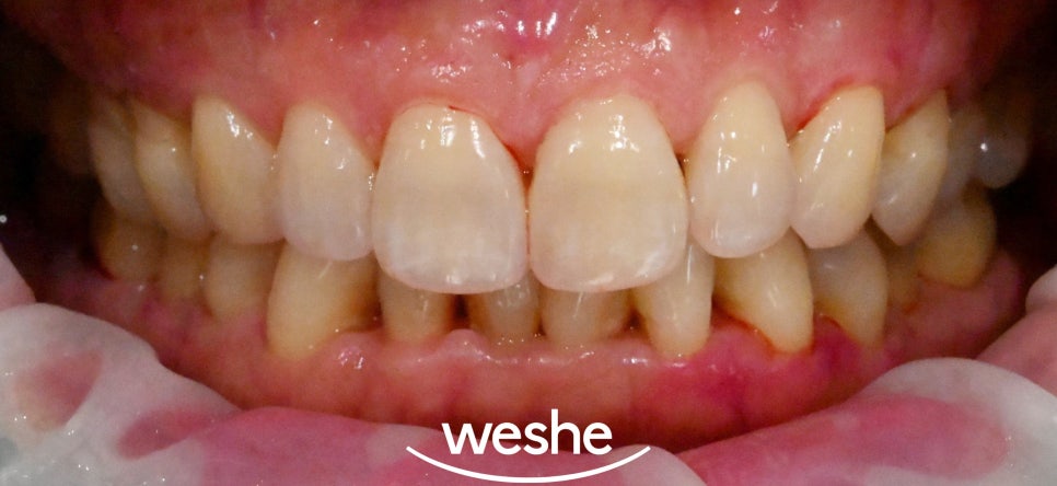 송정역 치과 잇몸 내려앉음이 나타날 때 할 수 있는 아랫니 치석 제거, 집에서도 할 수 있을까요? 관련 이미지 8