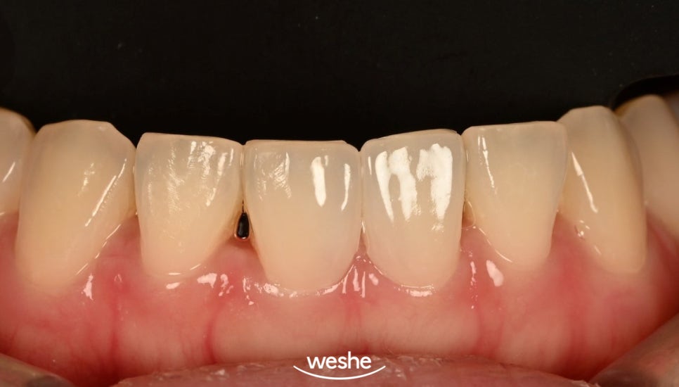 [마곡 치과] 교정 후 다시 벌어진 앞니, 재교정 없이 무삭제 라미네이트로 해결 하는 방법 을 알려드리겠습니다. (원내기공실) 관련 이미지 6