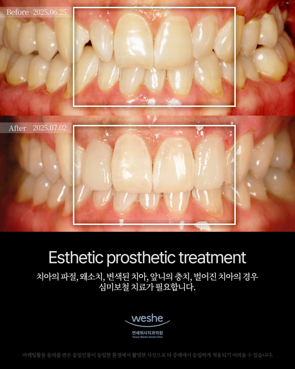 ✨ Esthetic Prosthetic Transformation &ndash; 라미네이트 치료 전후 ✨ 관련 이미지 1