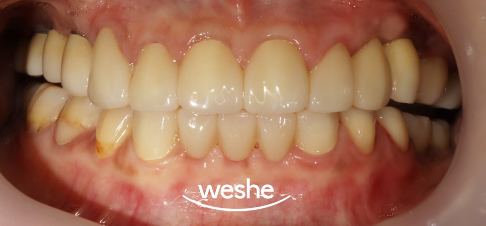 마곡역 치과 기공실과 기공소의 차이와 그에 따른 임플란트 진료 과정 관련 이미지 14
