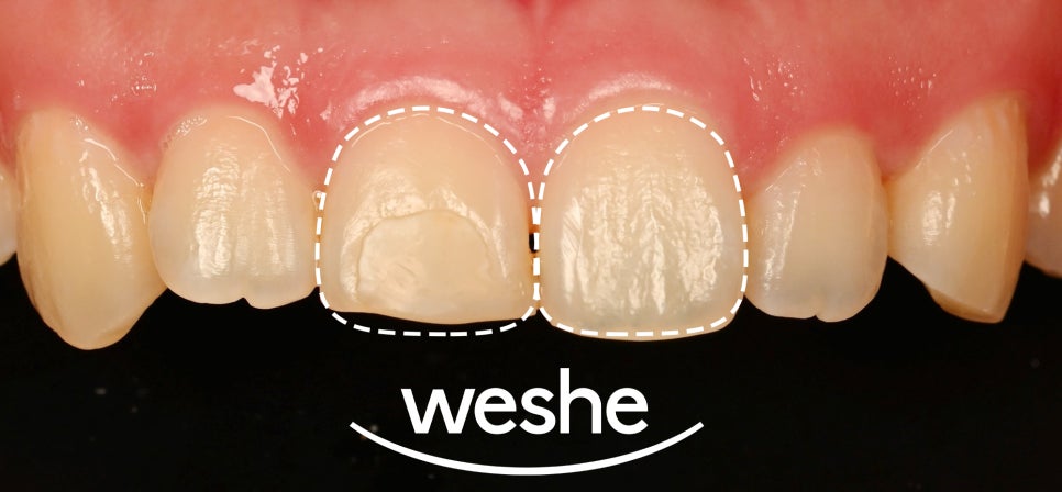 마곡 치과  앞니 깨짐, 크라운 없이 레진으로 치료가 가능할까? 진료 방법을 선택하는 기준과 과정 관련 이미지 2