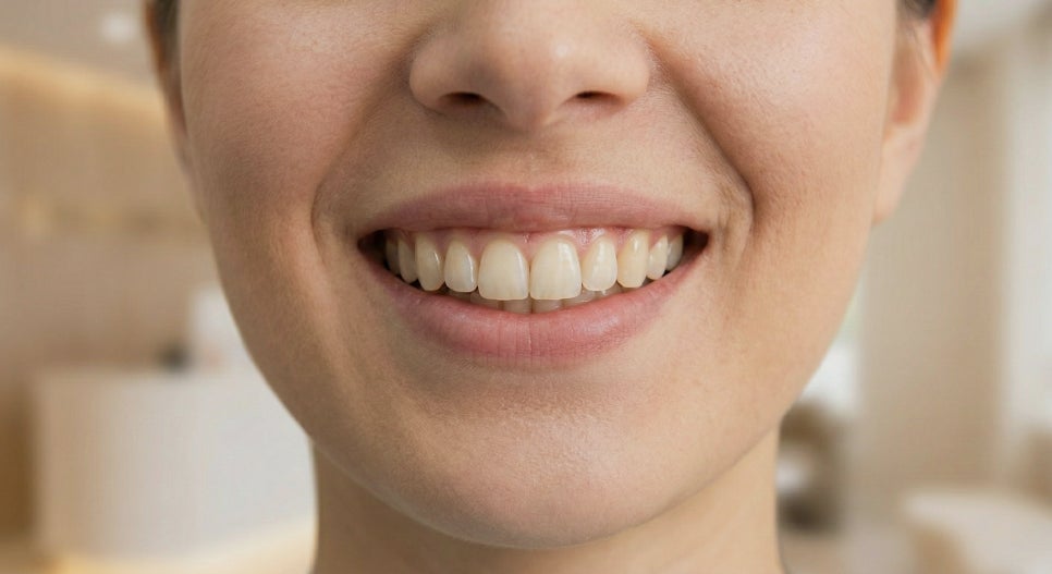 발산 치과 3월, 새 출발 앞두고치아 컴플렉스가 신경 쓰이신다면? 관련 이미지 5