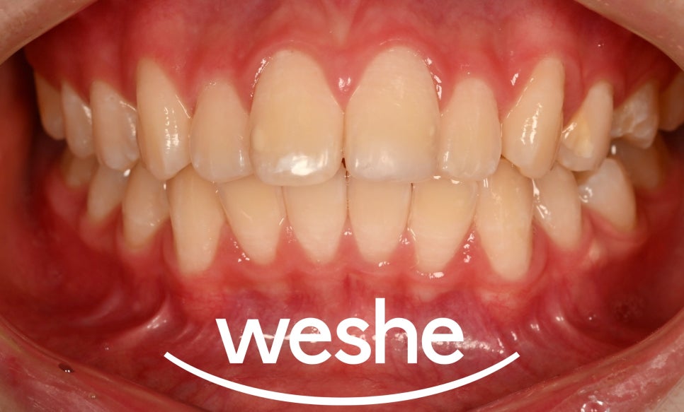 마곡동 치과 치아 파절 로 인한 레진 치료, 어떤 경우에 가능할까요? 관련 이미지 9