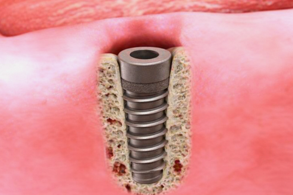 Gangseo-gu Dental Clinic: Have you given up on implants because of blood sugar or blood pressure? Reasons you should read this and think again image 1