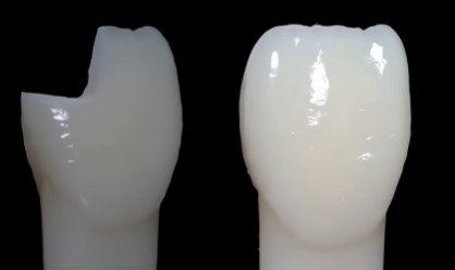 마곡동 치과 치아 파절 로 인한 레진 치료, 어떤 경우에 가능할까요? 관련 이미지 8