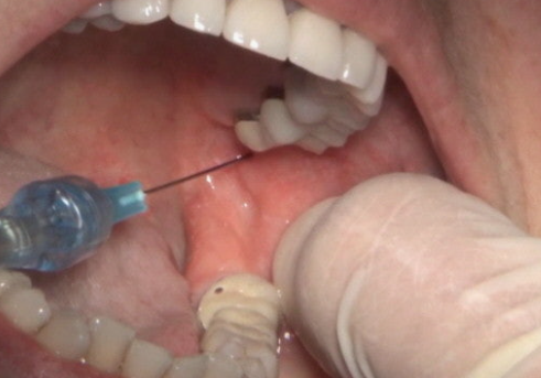 How Painful Is Dental Anesthesia? | Magok Dental Clinic image 5