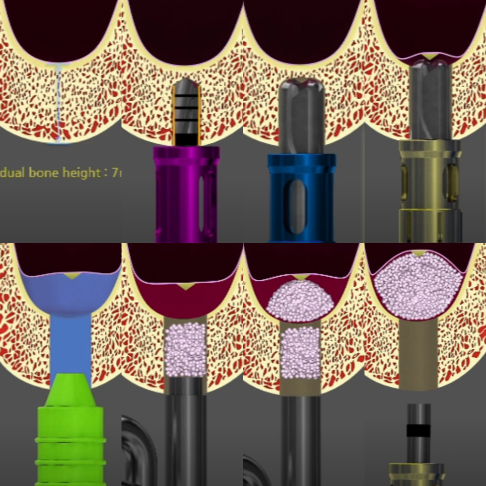 마곡역 치과 임플란트 식립 수술 시 필요한 상악동 거상술 종류 관련 이미지 2
