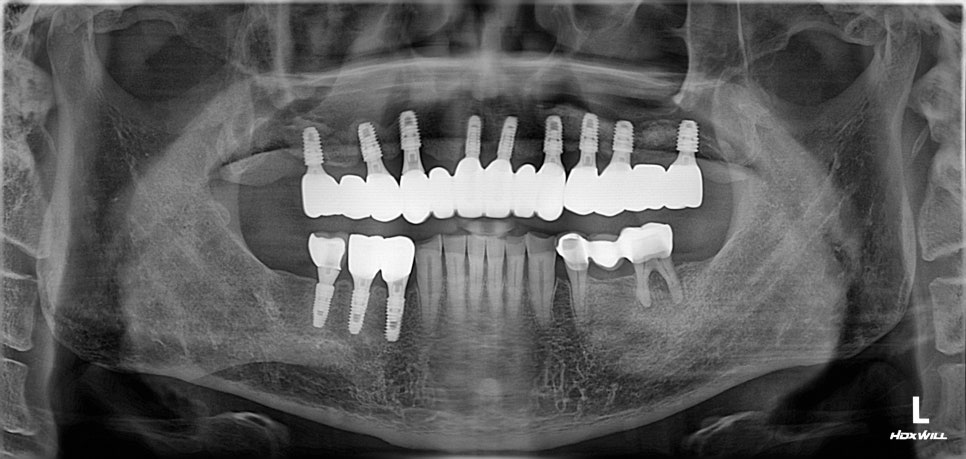 마곡 치과 수면마취(의식하진정법)을 이용한 임플란트 / 구역 반사가 심해도 괜찮은 이유 관련 이미지 3