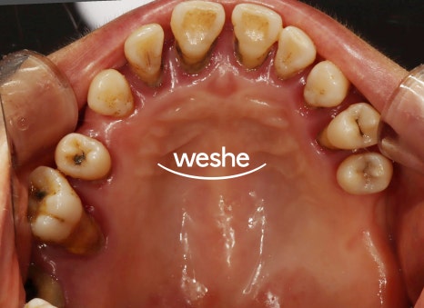 벌어진 치아 사이 (치간이개) 와 치주질환 이 동시에 있을 때, 송정역 치과 임플란트 치료 설명글 관련 이미지 7