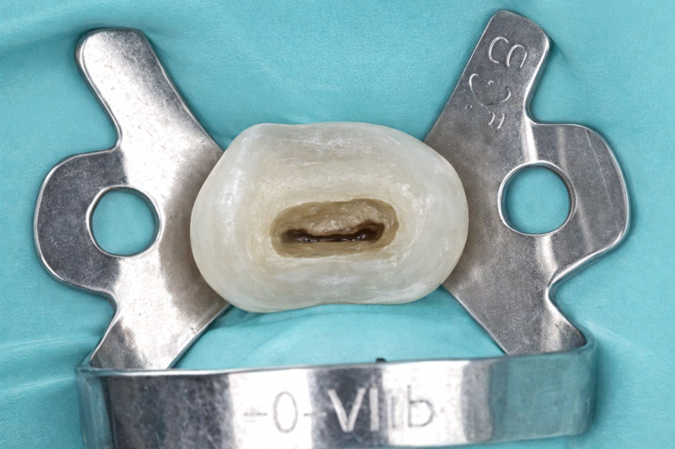 마곡역 치과 신경치료 후 크라운까지 마무리하는 진짜 이유와 지르코니아의 장점 관련 이미지 1