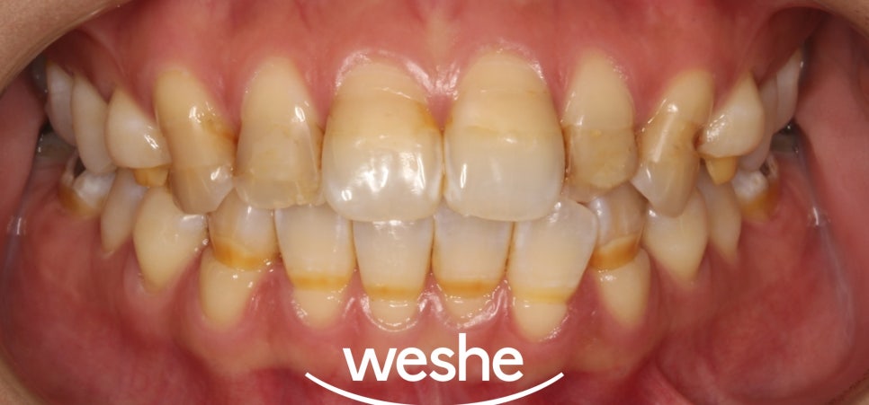 얼룩덜룩한 치아, 단순 착색, 변색일까요? 강서구 치과 법랑질 저형성증 치료법 소개글 관련 이미지 10