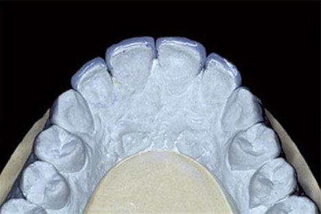 송정 치과 앞니 레진 변색 제거 후 전치부 치아 라미네이트 과정 관련 이미지 6