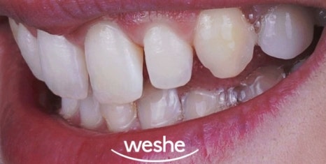 😁 웃을 때 치아 사이 가 벌어져 보인다면? 마곡동 치과 라미네이트 로 해결! 관련 이미지 4