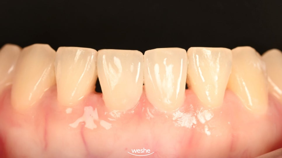 [마곡 치과] 교정 후 다시 벌어진 앞니, 재교정 없이 무삭제 라미네이트로 해결 하는 방법 을 알려드리겠습니다. (원내기공실) 관련 이미지 5