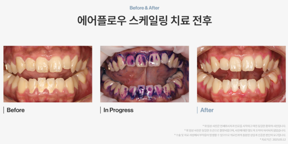 좋은 치과는 치료보다 관리를 먼저 생각합니다- 에어플로우 스케일링 연세위시치과 관련 이미지 1